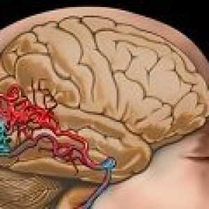 Zúžení cerebrovaskulárních příčiny, léčba