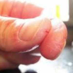 Popraskané kůže na rukou - příčiny, léčba