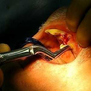Extrakce zubů