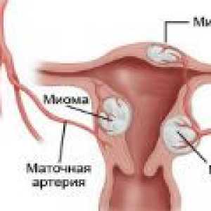 Tvárné děložní myomy - příčiny, příznaky, léčba