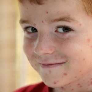 Plané neštovice u dětí symptomy a léčbu