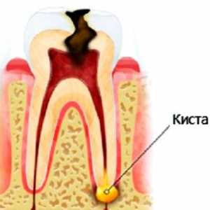 Je možné léčit zubní cysty, bez demontáže