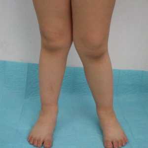 Vrozená dysplazie kolena