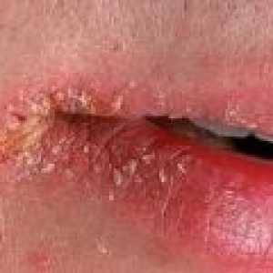 Perleches koutky úst: symptomy, příčiny, léčba