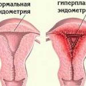 Glandulocystica hyperplazie endometria