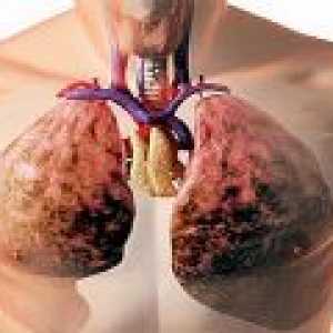 Tekutina v plicích příčinách, symptomy, léčba
